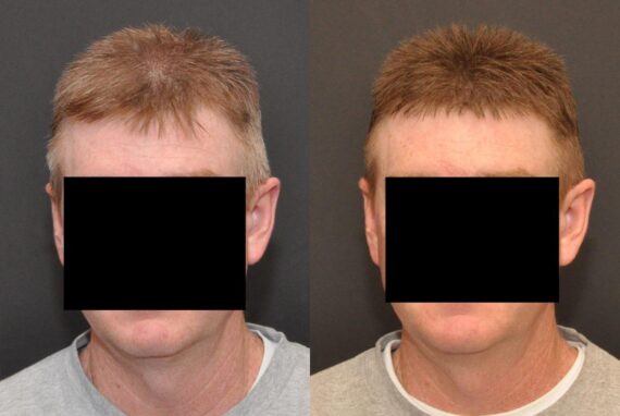 Hair Transplantation Before and After Photos in Cincinnati, OH, Patient 5822