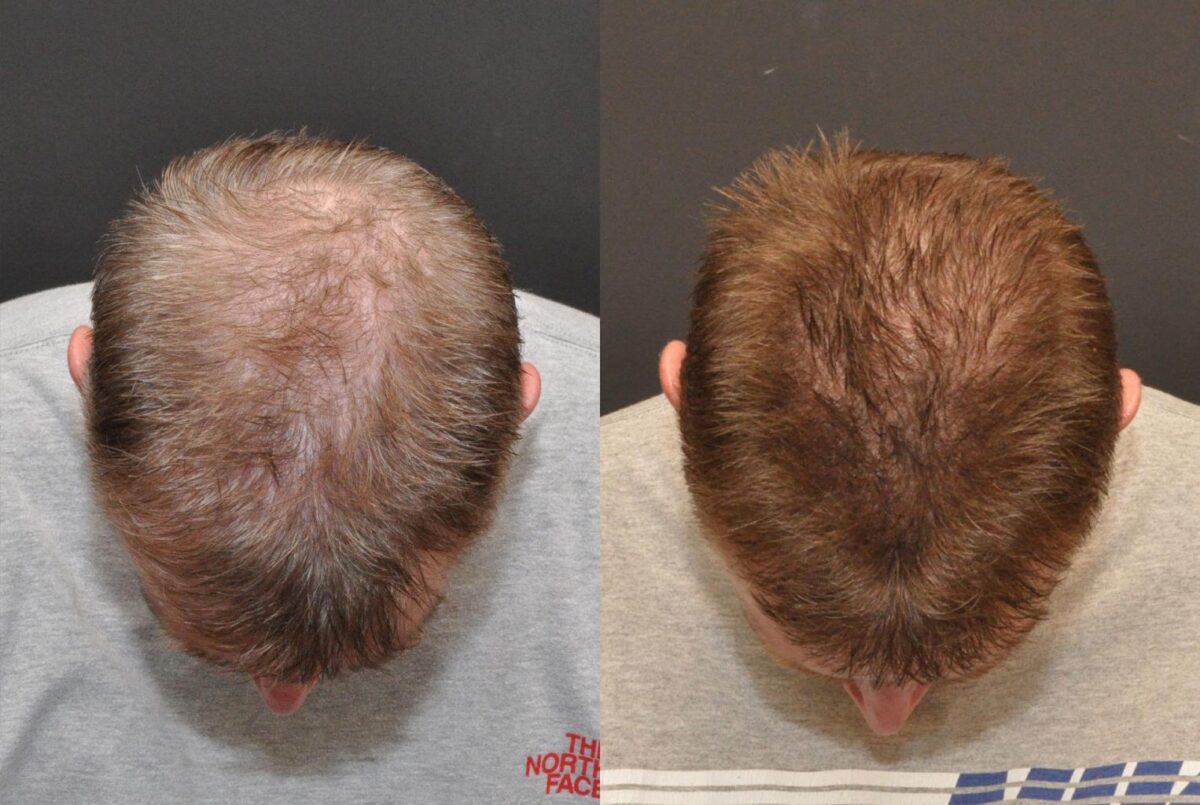 Hair Transplantation Before and After Photos in Cincinnati, OH, Patient 5822