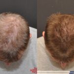 Hair Transplantation Before and After Photos in Cincinnati, OH, Patient 5822