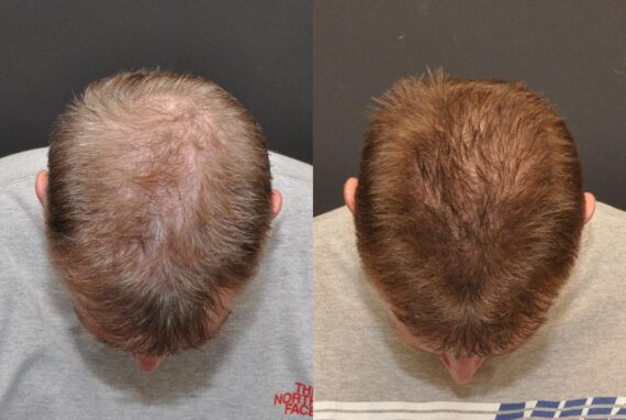 Hair Transplantation Before and After Photos in Cincinnati, OH, Patient 5822
