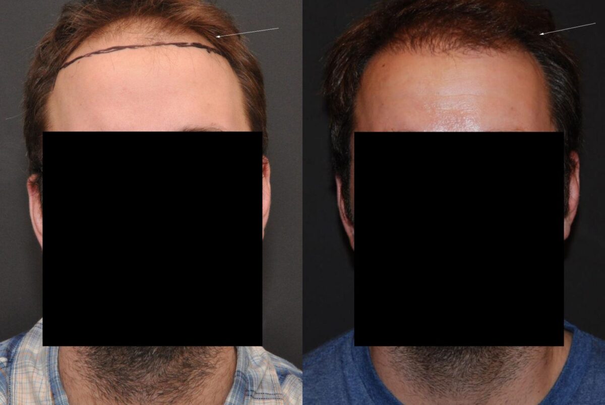 Hair Transplantation Before and After Photos in Cincinnati, OH, Patient 5827