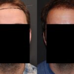 Hair Transplantation Before and After Photos in Cincinnati, OH, Patient 5827