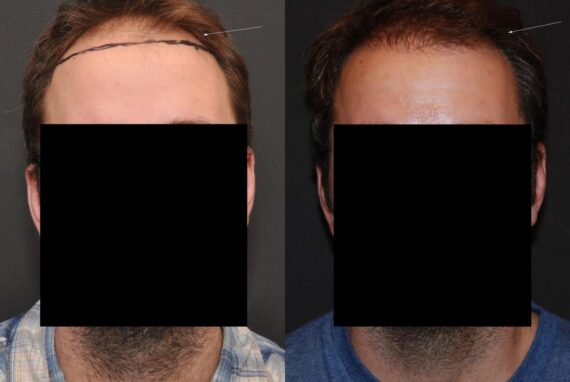 Hair Transplantation Before and After Photos in Cincinnati, OH, Patient 5827