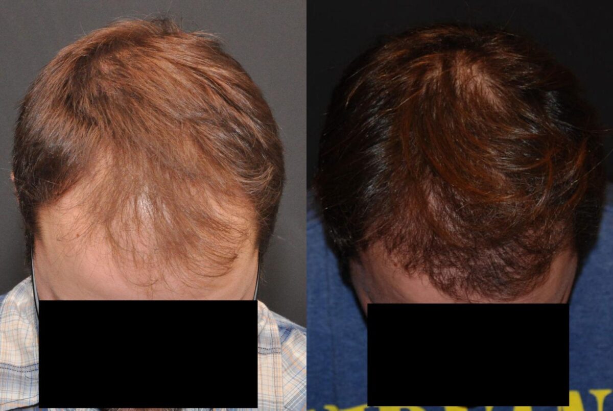 Hair Transplantation Before and After Photos in Cincinnati, OH, Patient 5827