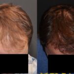 Hair Transplantation Before and After Photos in Cincinnati, OH, Patient 5827
