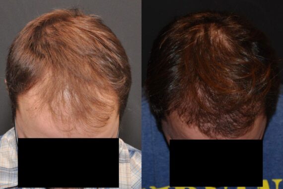 Hair Transplantation Before and After Photos in Cincinnati, OH, Patient 5827