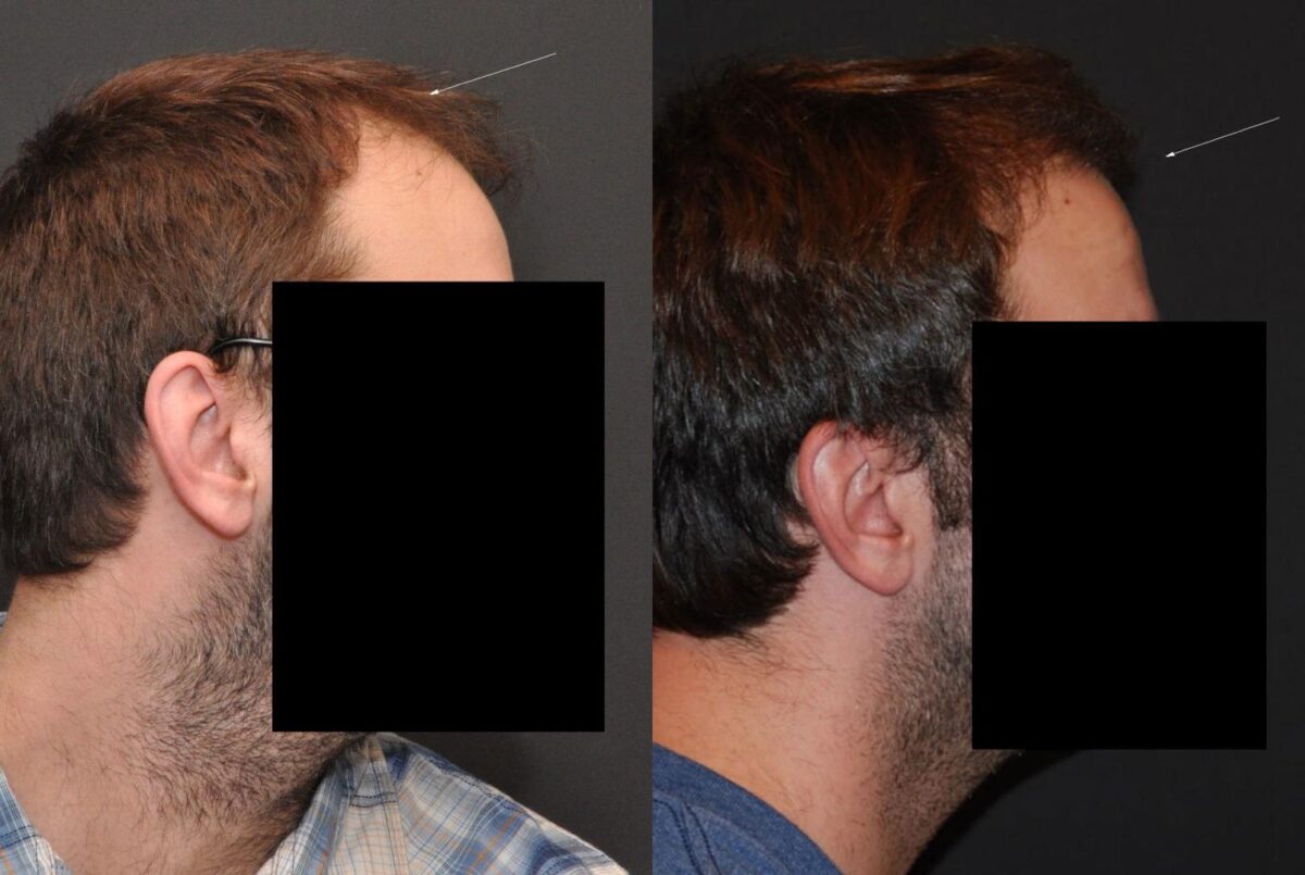 Hair Transplantation Before and After Photos in Cincinnati, OH, Patient 5827