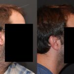 Hair Transplantation Before and After Photos in Cincinnati, OH, Patient 5827