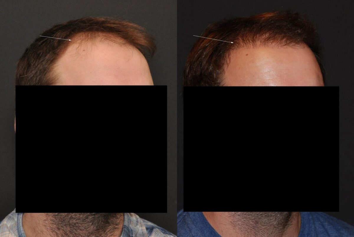 Hair Transplantation Before and After Photos in Cincinnati, OH, Patient 5827