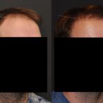 Hair Transplantation Before and After Photos in Cincinnati, OH, Patient 5827
