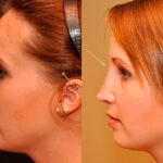 Injection Rhinoplasty Before and After Photos in Cincinnati, OH, Patient 5839