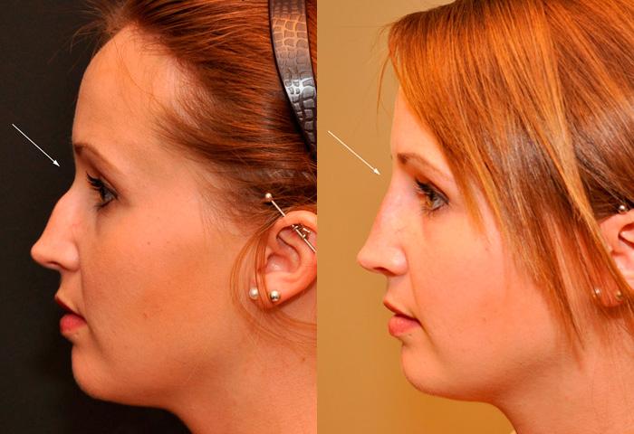 Injection Rhinoplasty Before and After Photos in Cincinnati, OH, Patient 5839