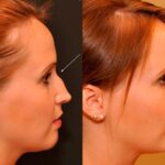 Injection Rhinoplasty Before and After Photos in Cincinnati, OH, Patient 5839