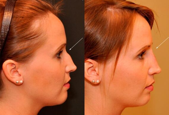 Injection Rhinoplasty Before and After Photos in Cincinnati, OH