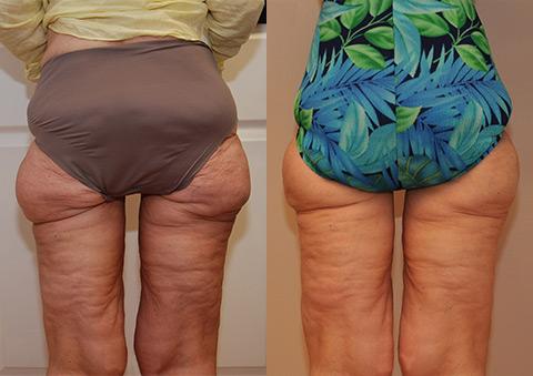 Liposonix Before and After Photos in Cincinnati, OH