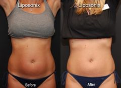 Liposonix Before and After Photos in Cincinnati, OH, Patient 5849