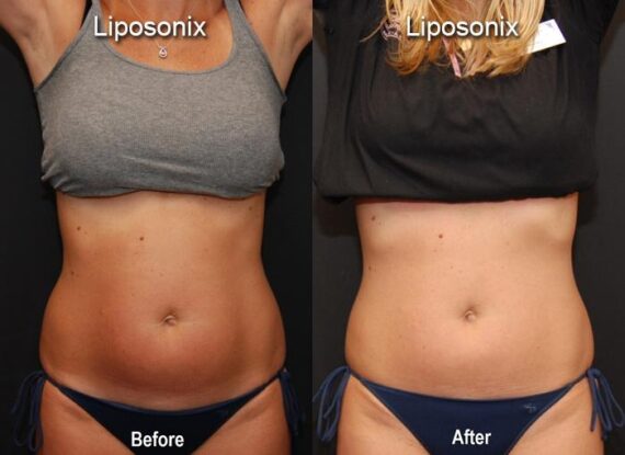 Liposonix Before and After Photos in Cincinnati, OH