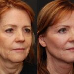 LuxeLift Before and After Photos in Cincinnati, OH, Patient 5859