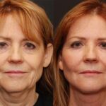 LuxeLift Before and After Photos in Cincinnati, OH, Patient 5859