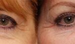 LuxeLift Before and After Photos in Cincinnati, OH, Patient 5859