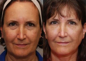 LuxeLift Before and After Photos in Cincinnati, OH, Patient 5878