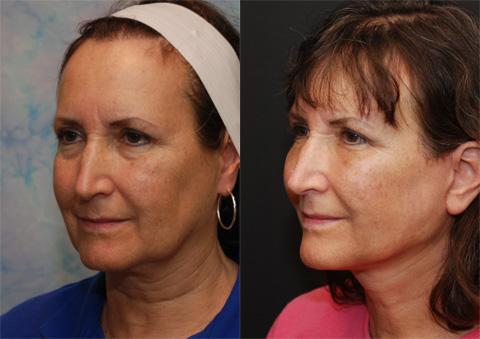LuxeLift Before and After Photos in Cincinnati, OH, Patient 5878