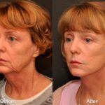 LuxeLift Before and After Photos in Cincinnati, OH, Patient 5883