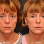 LuxeLift Before and After Photos in Cincinnati, OH, Patient 5883