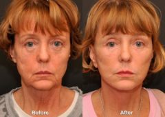 LuxeLift Before and After Photos in Cincinnati, OH, Patient 5883