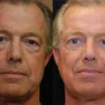 Male Plastic Surgery Before and After Photos in Cincinnati, OH, Patient 5895