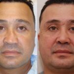 Male Plastic Surgery Before and After Photos in Cincinnati, OH, Patient 5900