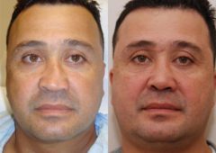 Male Plastic Surgery Before and After Photos in Cincinnati, OH, Patient 5900