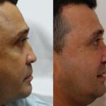Male Plastic Surgery Before and After Photos in Cincinnati, OH, Patient 5900