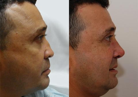 Male Plastic Surgery Before and After Photos in Cincinnati, OH, Patient 5900