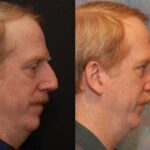 Male Plastic Surgery Before and After Photos in Cincinnati, OH, Patient 5905