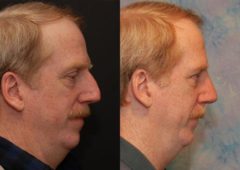 Male Plastic Surgery Before and After Photos in Cincinnati, OH, Patient 5905