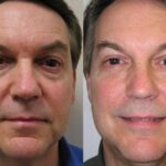 Male Plastic Surgery Before and After Photos in Cincinnati, OH, Patient 5908