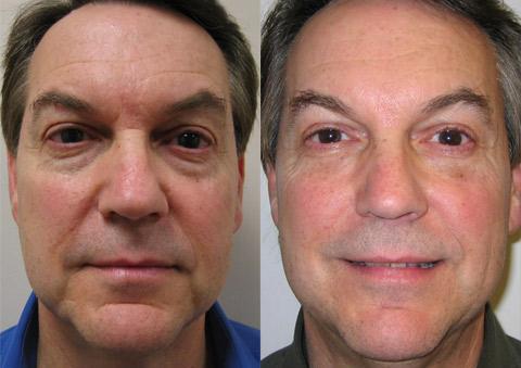 Male Plastic Surgery Before and After Photos in Cincinnati, OH, Patient 5908