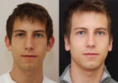 Male Plastic Surgery Before and After Photos in Cincinnati, OH, Patient 5911