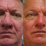 Male Plastic Surgery Before and After Photos in Cincinnati, OH, Patient 5924