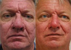 Male Plastic Surgery Before and After Photos in Cincinnati, OH, Patient 5924