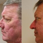 Male Plastic Surgery Before and After Photos in Cincinnati, OH, Patient 5924