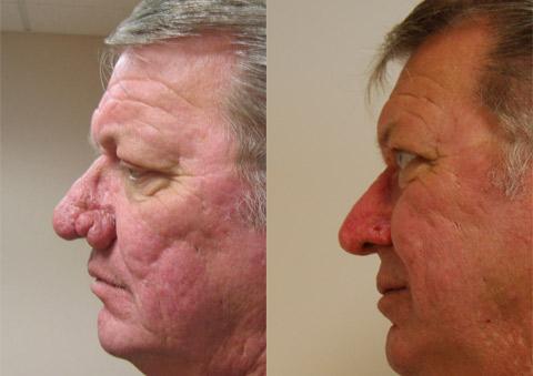 Male Plastic Surgery Before and After Photos in Cincinnati, OH, Patient 5924