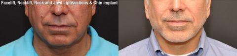 Male Plastic Surgery Before and After Photos in Cincinnati, OH, Patient 5929