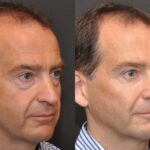 Male Plastic Surgery Before and After Photos in Cincinnati, OH, Patient 5936