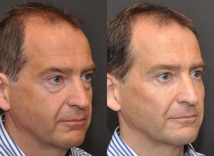 Male Plastic Surgery Before and After Photos in Cincinnati, OH, Patient 5936