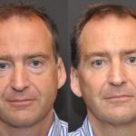 Male Plastic Surgery Before and After Photos in Cincinnati, OH, Patient 5936