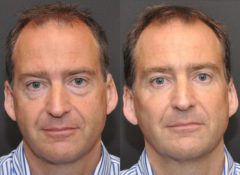 Male Plastic Surgery Before and After Photos in Cincinnati, OH, Patient 5936