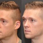 Male Plastic Surgery Before and After Photos in Cincinnati, OH, Patient 5941