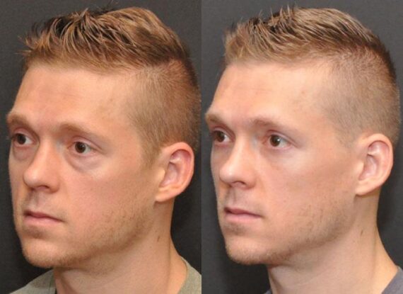 Male Plastic Surgery Before and After Photos in Cincinnati, OH, Patient 5941